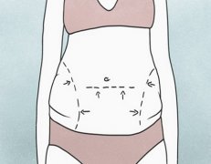 腰腹抽脂多久定型最瘦、消肿时间及保持时间