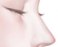 隆鼻想长久建议硅胶还是膨体？硅胶、膨体材料区别详细分析