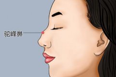 珠海科美隆鼻案例公开，制定个性化方案，服务周到耐心